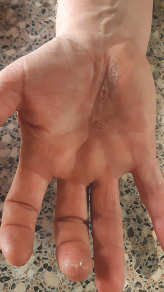 Vergrößerung des Bildes für Hand mit kranker Haut.